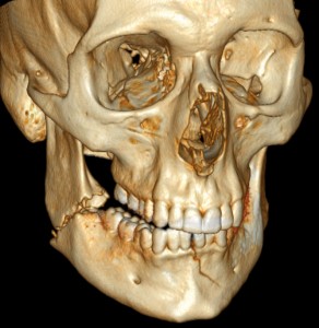 3D_CT_of_bilateral_mandible_fracture