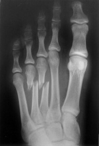 broken_foot