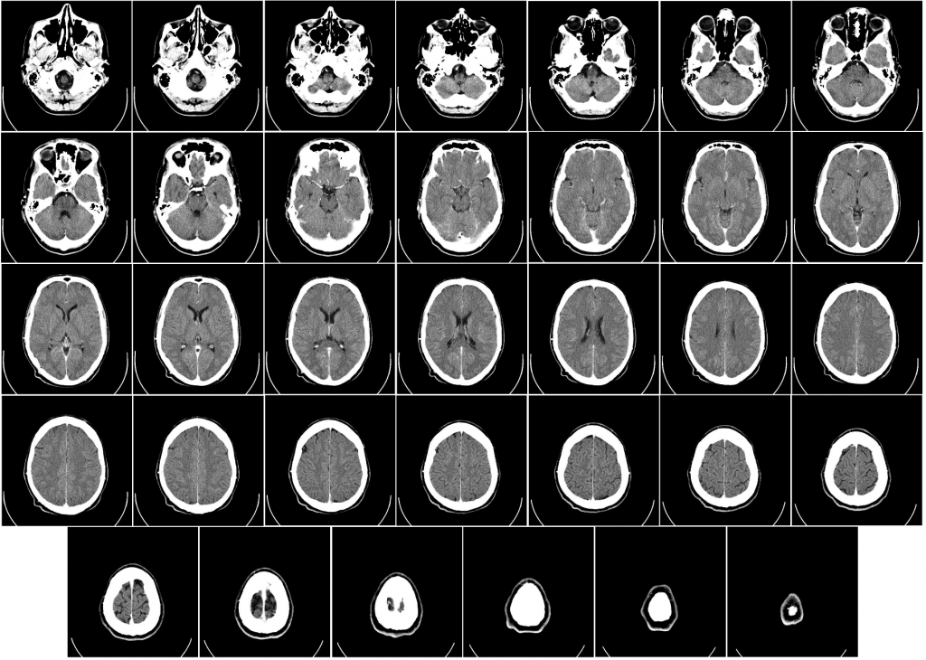 Computed_tomography_of_human_brain_scale